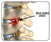 Lumbar Spondylosis